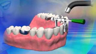 Details Lingual Bracket Jig direct bonding News