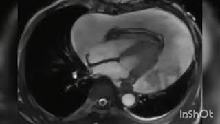 a dancing heart  #heart #anatomy #physiology #mbbs #medical #biology #interesting #vadio