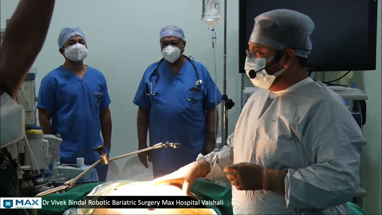 Robotic Sleeve Gastrectomy Sureform staplers (Unedited Live