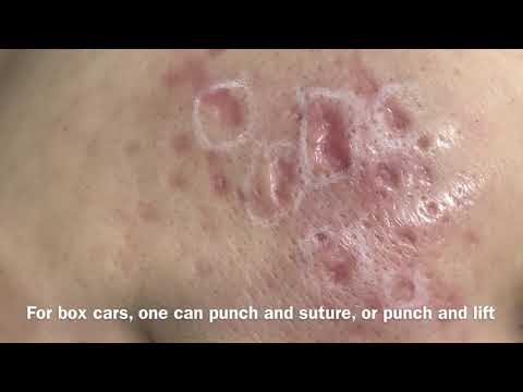 Acne scar punch/lift