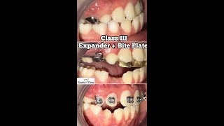 How long do you have to wear an expander in Class III? - RPE + Bite Plate -  Tooth Time NBTX