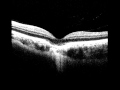 Focal choroidal excavation