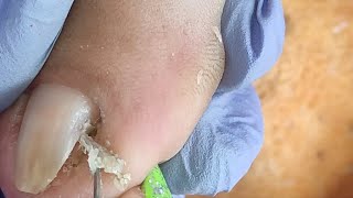 Part 2 Sobrang Daming Dry Skin Nakuha Sa Paa