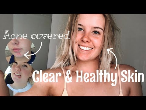 How I CURED My HORMONAL ACNE- Skincare, Supplements & Diet