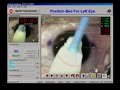 2003   laser eye surgery  michael weinbaum 2003