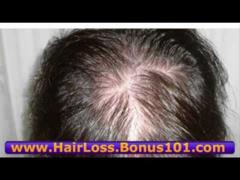 Regrow Hair Alopecia How To Regrow Hair Quickly Regrow Hair
