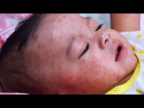 Disneyland measles outbreak