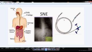 SNE, SNG, Gastrostomia e Jejunostomia (Básico)