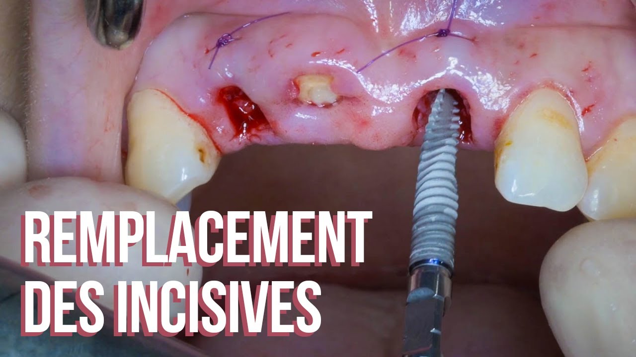 Remplacement des incisives antérieures maxillaires de 12 à 21