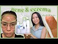 How I Treat My Acne & Eczema 🧴 Skincare Faves + Tips (redness, texture, dyshidrosis)