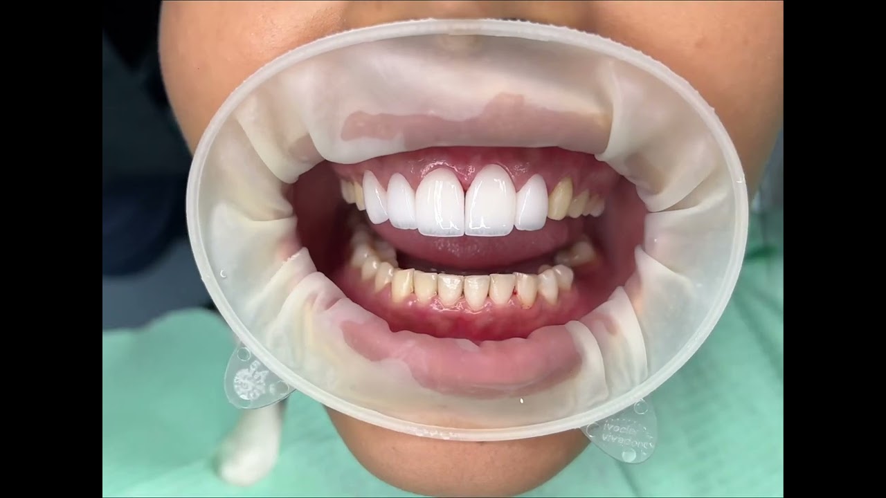 Instalacion de Lentes cerámicos Emax color BL1 porcelainveneers 💎💎💎