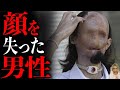事故で顔が溶けてしまった男の衝撃過ぎるその末路とは…
