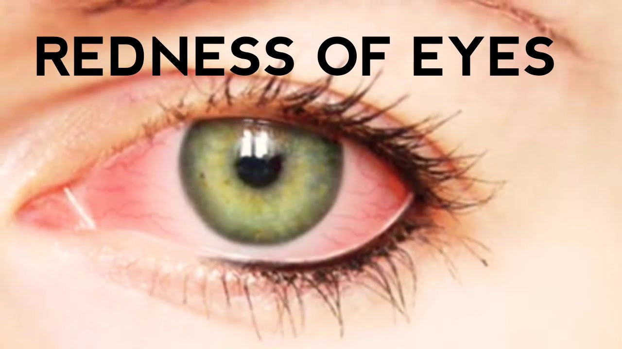 Natural Remedy for Eye Redness.. 100 natural , Coconut oil for eyes