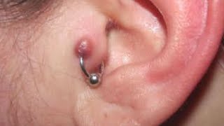 how to get rid of an ear piercing bump at home