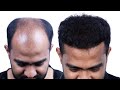 Grade 7 hair transplant results bangladesh  new roots hair transplant 