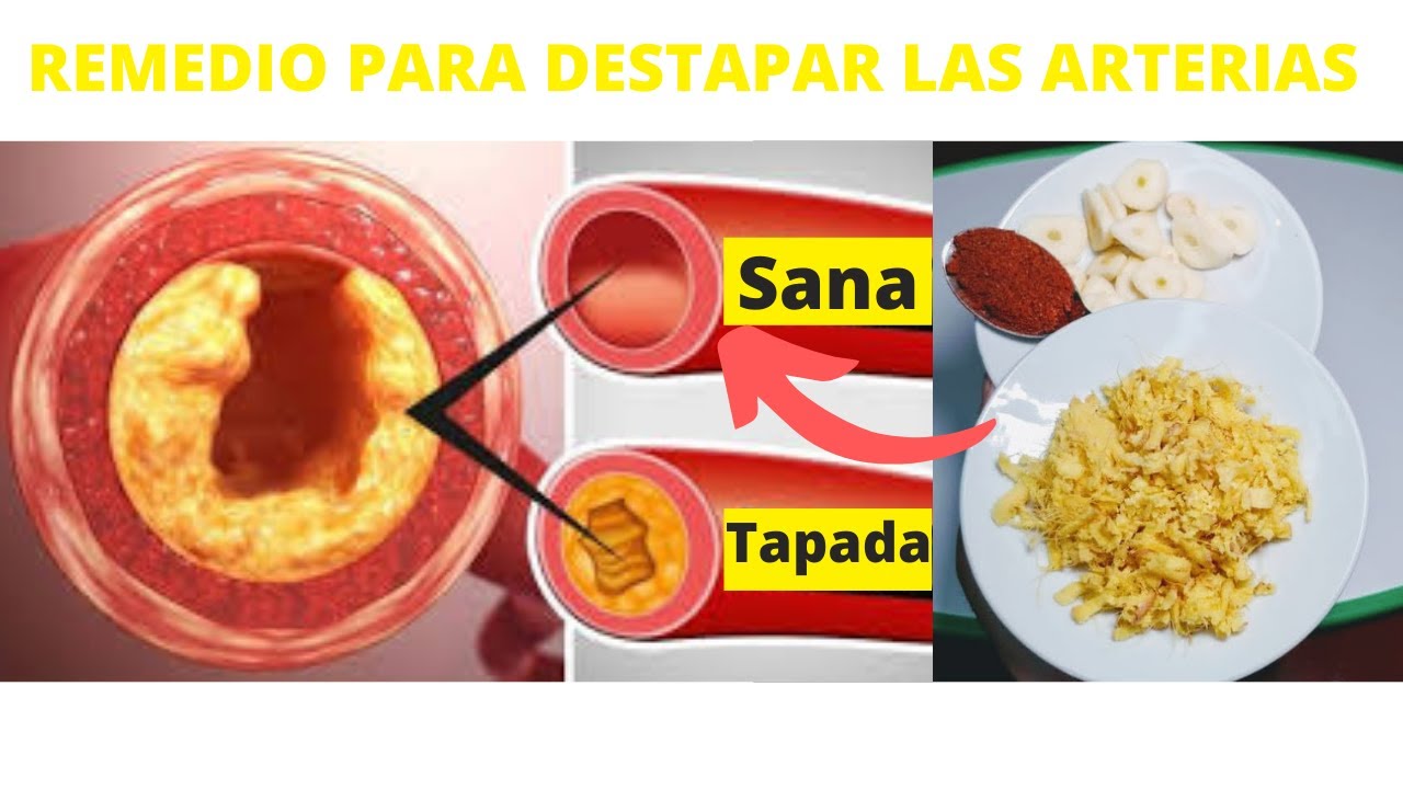 REMEDIO PARA DESTAPAR LAS ARTERIAS SI TIENE PRESIÓN ALTA Y CANSANCIO