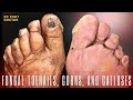 Fungal Toenails, Corns, and Calluses:  Diabetic Foot Care