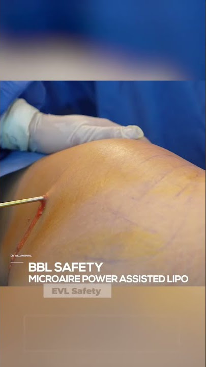 How to safely inject fat during a BBL! #plasticsurgery #shorts #bbl #liposuction #tummytuck