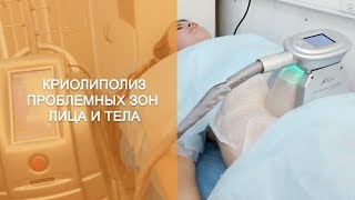 Криолиполиз. Безоперационная липосакция методом криолиполиза Криолиполиз. Безоперационная липосакция методом криолиполиза
