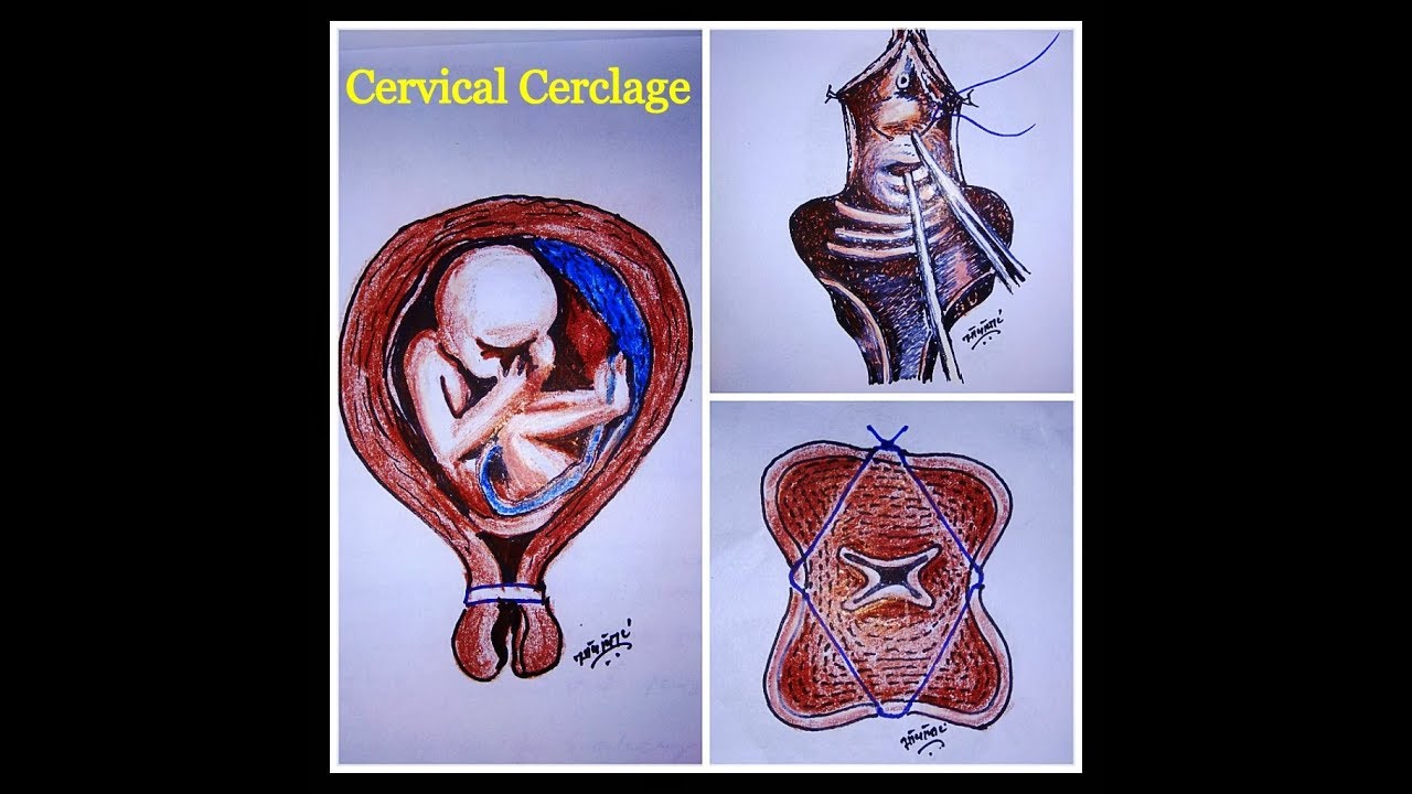 Cervical Cerclage Procedure Hiccups Pregnancy