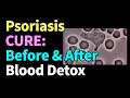 Psoriasis Reversed: Witness My Blood Cells Transform After Detoxifying 4 Toxins