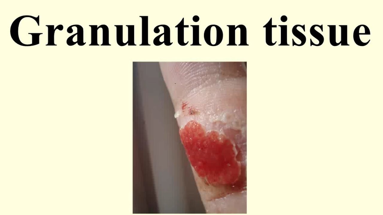 Granulation Tissue - YouTube.