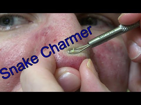 Nose Mania | Life With Cystic Acne Documentary #