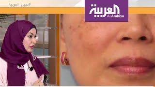 صباح العربية: كيف تتخلص من تصبغات الجلد