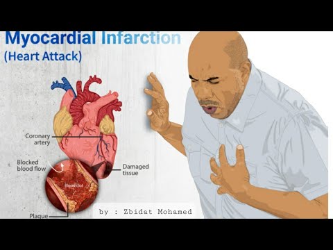 איך מאבחנים התקף לב באק"ג (ECG )| עקרונות ודגשים .