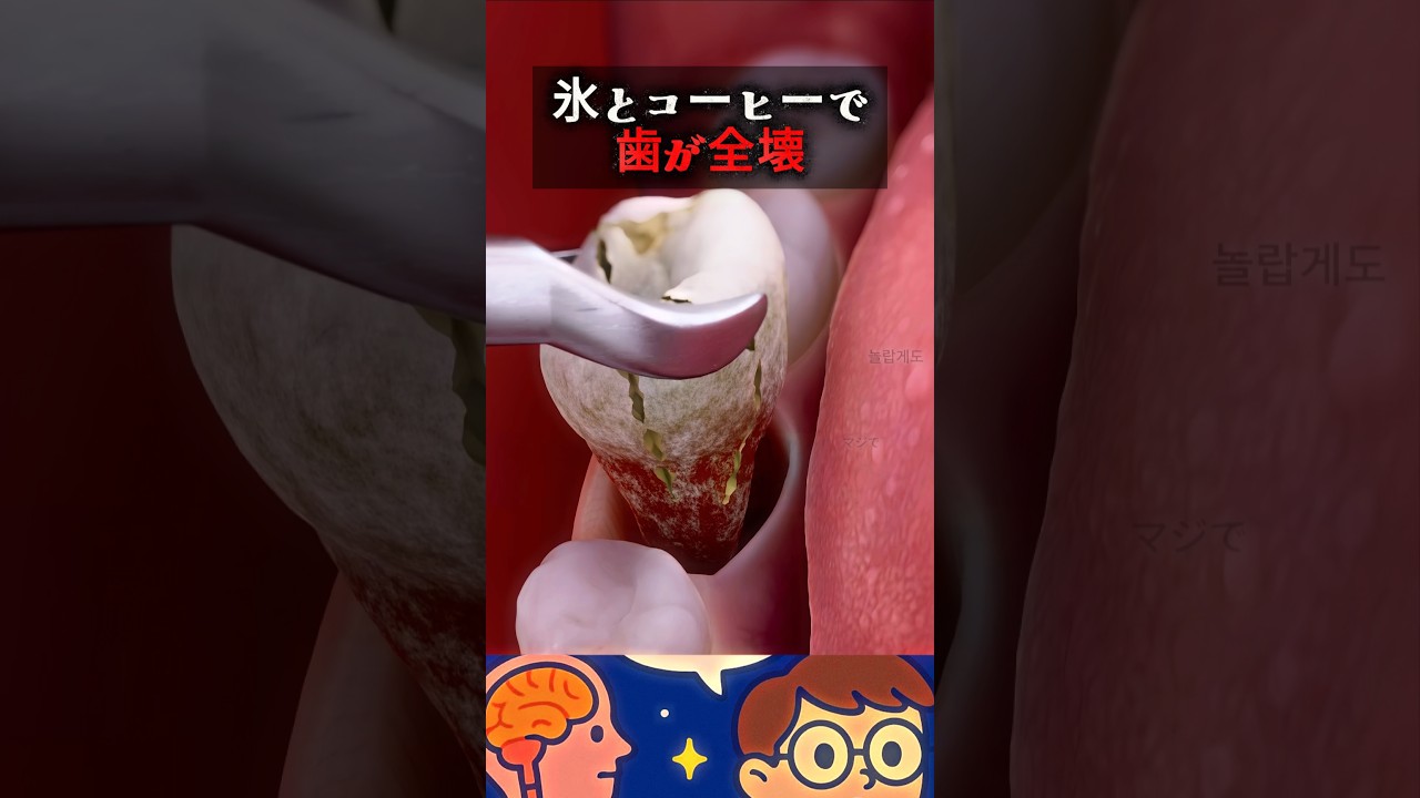 氷とコーヒーで 歯が全壊