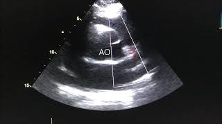 Coronary artery fistula  - MD Sonography