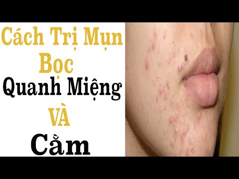 Cách Trị Mụn Bọc Quanh Miệng Và Cằm - Mỹ Phẩm SOSENCO