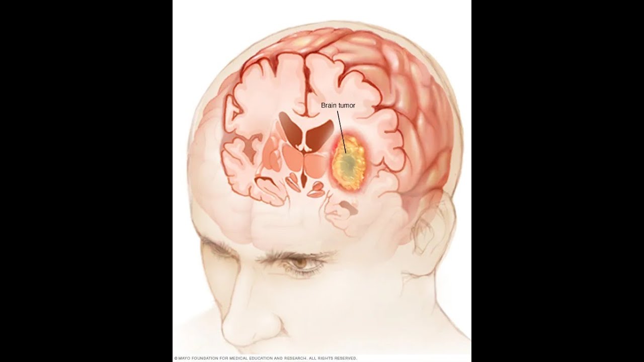 Глиальная опухоль головного. Неоперабельная глиобластома головного мозга.. Злокачественная глиома. Глиальные опухоли мозга.
