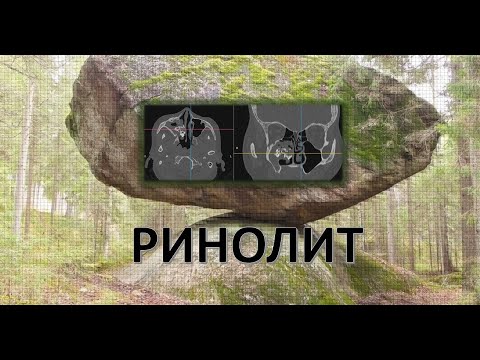 РИНОЛИТ - ИНОРОДНОЕ ТЕЛО НОСА - МИЦЕТОМА - ГРИБКОВОЕ ТЕЛО ВЕРХНЕЧЕЛЮСТНОЙ ПАЗУХИ НОСА. ГАЙМОРОТОМИЯ