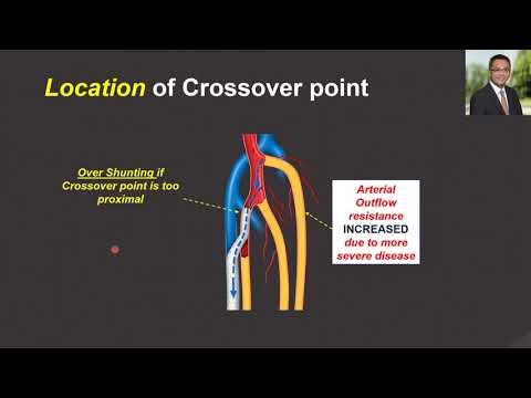 3h55pm   EVS Fellow 14 october 2021   Steven Kum   Deep Venous Arterialization