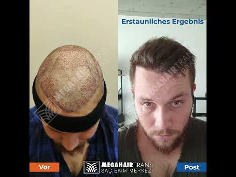 4000 Haartransplantationen wurden