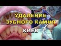 Чистка зубов (видео). Удаление зубного камня - Киев, Люми-Дент