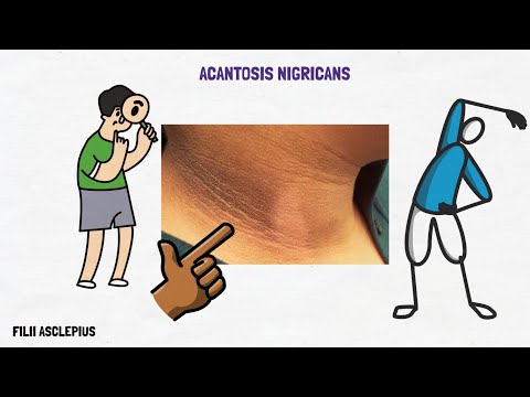 Video: ¿Puede el embarazo causar acantosis nigricans?