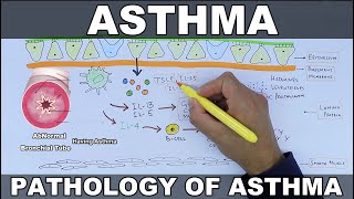 Asthma | Pathophysiology of Asthma