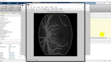 Retinal Disease using matlab code |ieee matlab image processing projects at bangalore