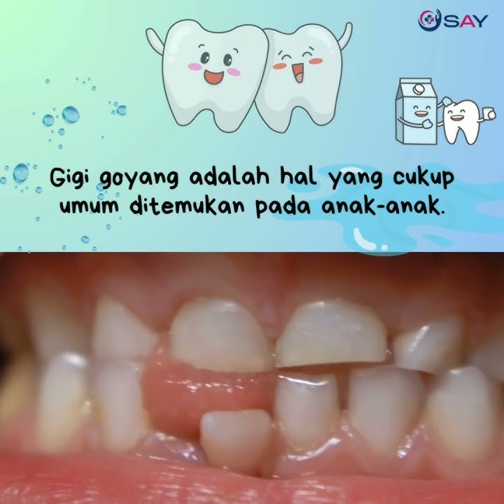 Gigi Goyang Pada Anak 👧 #doktergigi #doktergigiku #dentist #edukasi