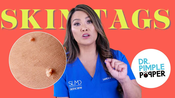 Ask Dr. Pimple Popper | Skin Tags & Acne Scars