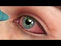 Medicina para todos: conjuntivitis