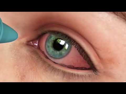 Vídeo: Emoxipin - Instrucciones De Uso, Precio, Revisiones, Gotas Para Los Ojos