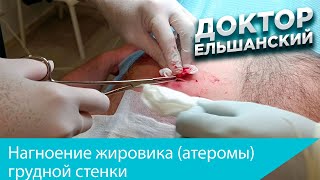 Нагноение жировика (атеромы) грудной стенки