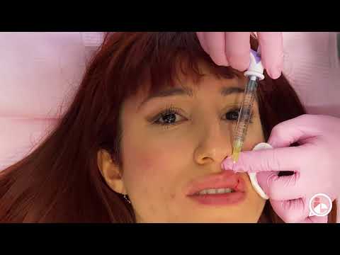Video: Rimodellamento Delle Labbra - Metodi, Condotta, Recensioni