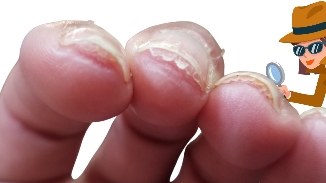 why-is-the-nail-separating-from-nail-bed-nail-bed-hyperkeratosis