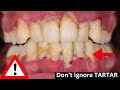What Happens If TARTAR Is Not Removed ?