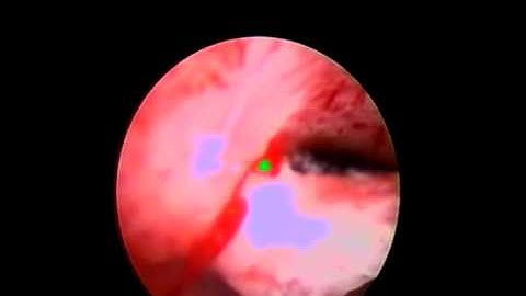Hysteroscopic polypectomy Dr Mahmoud ismail