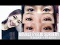 Non-Invasive Double Eyelid Procedure - Recovery Process || FATFOAL